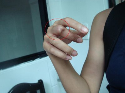 Woman whose finger was dislocated by the Taiwanese police after  she tried to raise a Tibetan flag protesting the visit of Chinese Communist Party negotiator Chen Yunlin