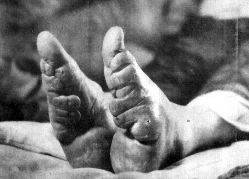 Horribly curled toes due to Chinese foot binding.