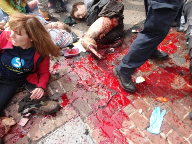 Boston Bombing victim - man with lost leg (all that remains is the bare shin bone)